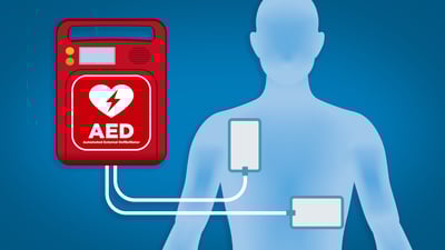 AED: Jumper Cables for the Heart